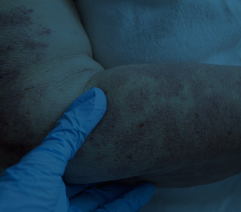 Scleroderma